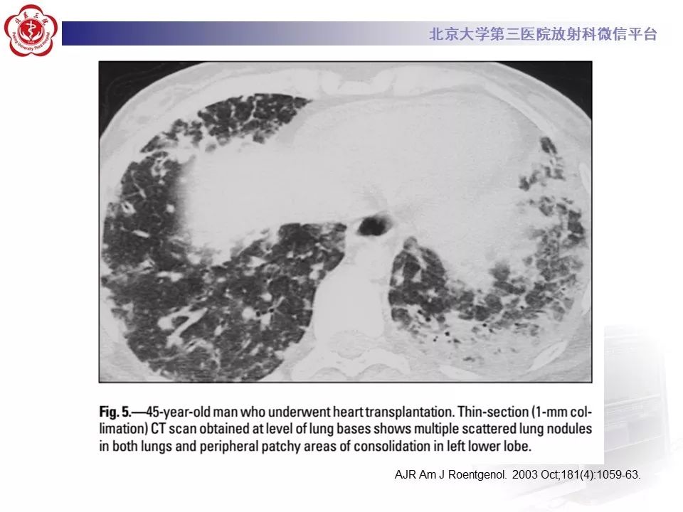 【病例】巨细胞病毒性肺炎1例CT影像