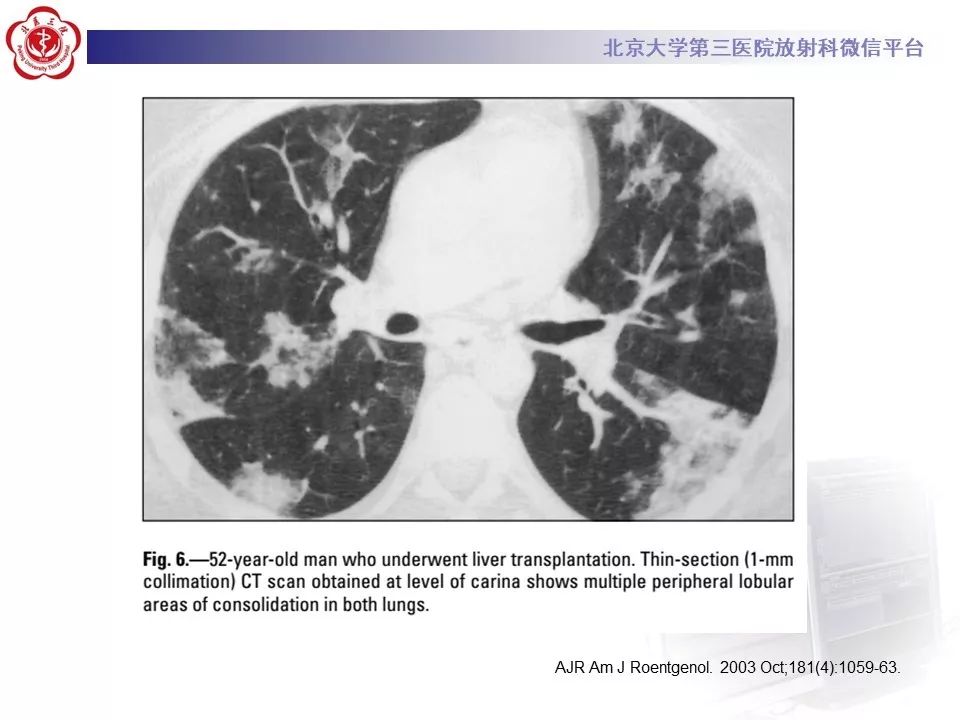 【病例】巨细胞病毒性肺炎1例CT影像