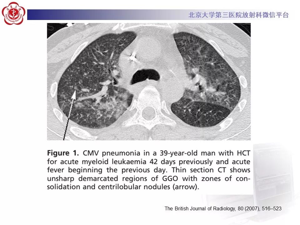 【病例】巨细胞病毒性肺炎1例CT影像
