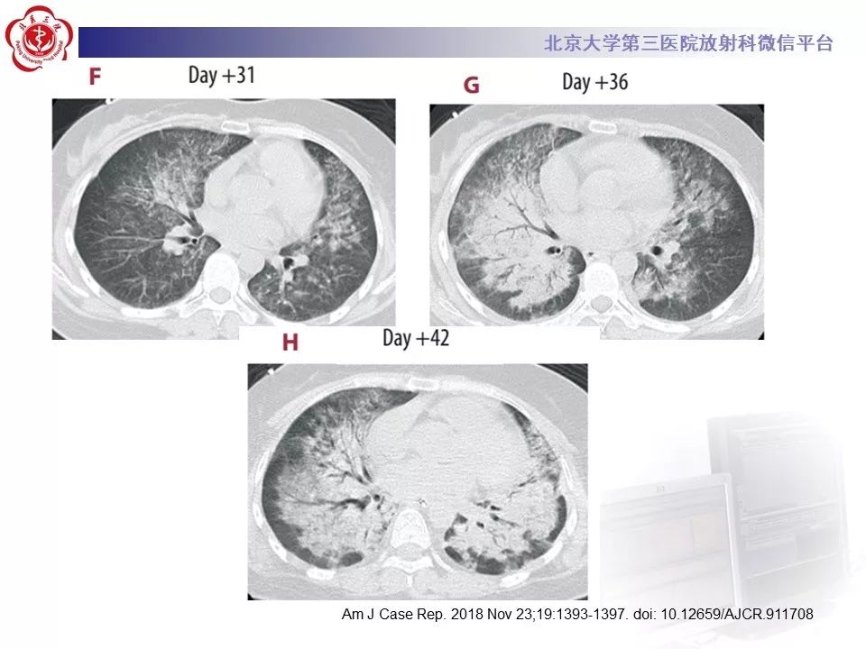 【病例】巨细胞病毒性肺炎1例CT影像