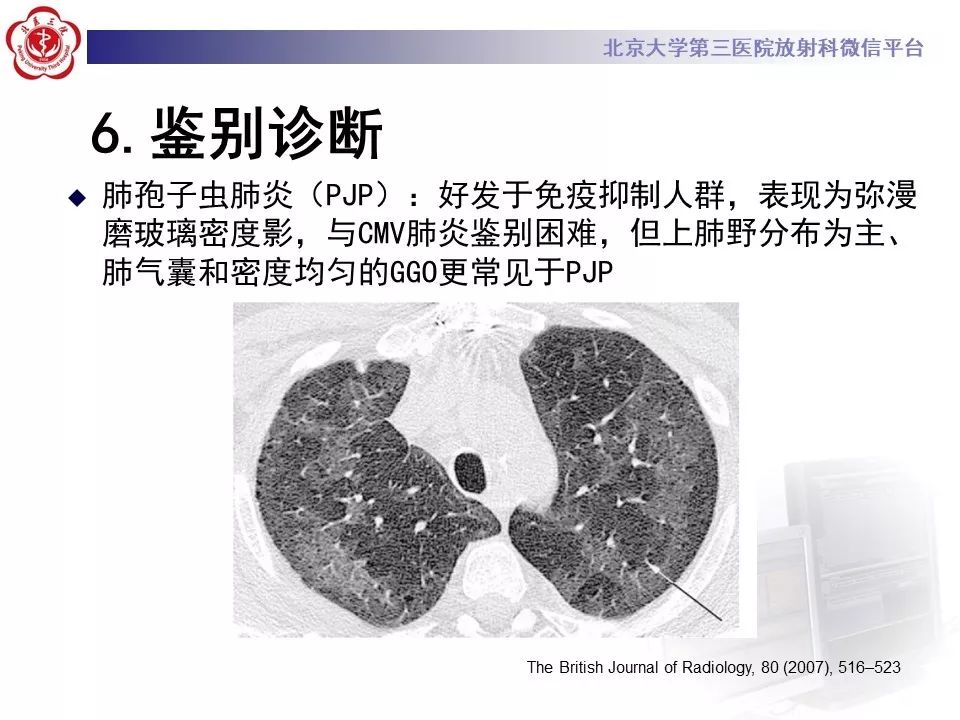 【病例】巨细胞病毒性肺炎1例CT影像