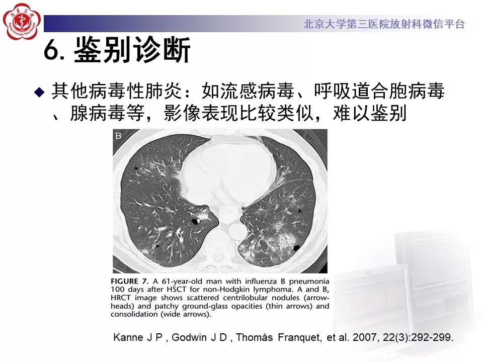 【病例】巨细胞病毒性肺炎1例CT影像