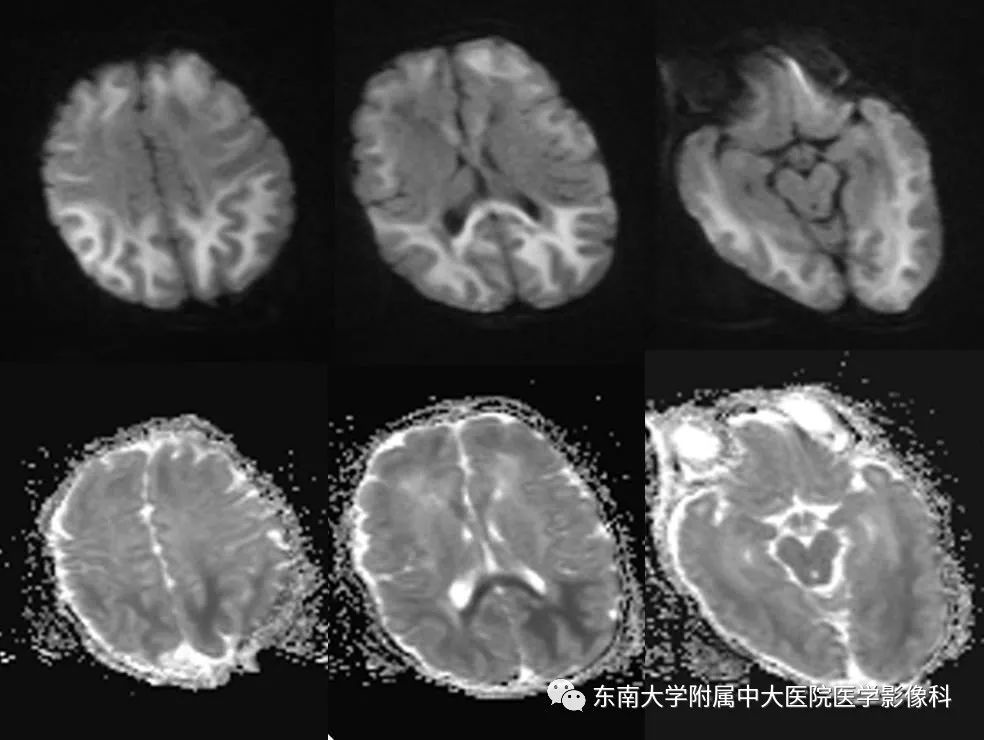 【病例】新生儿低血糖脑病2例MR影像