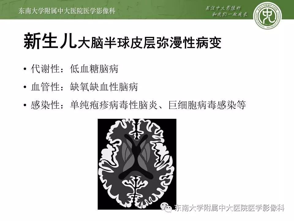 【病例】新生儿低血糖脑病2例MR影像