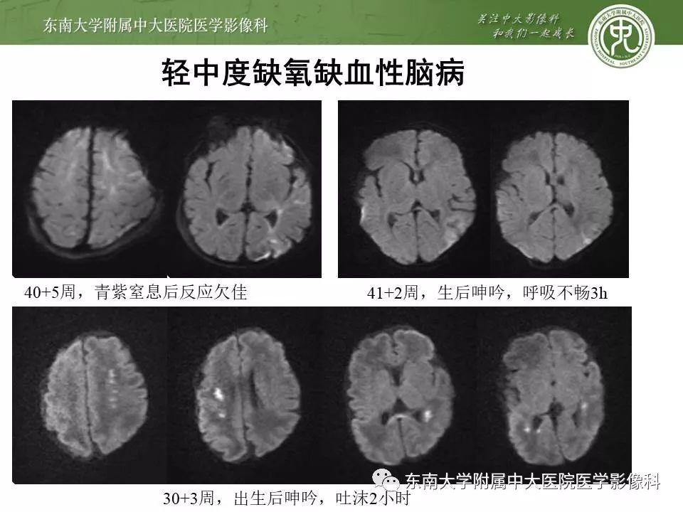 【病例】新生儿低血糖脑病2例MR影像