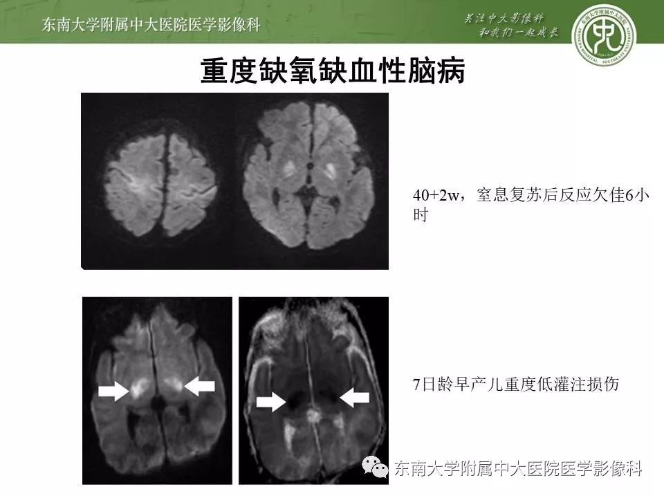 【病例】新生儿低血糖脑病2例MR影像