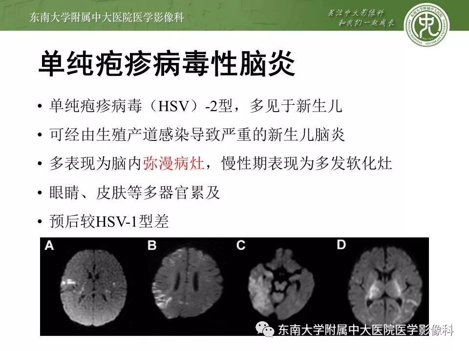 【病例】新生儿低血糖脑病2例MR影像