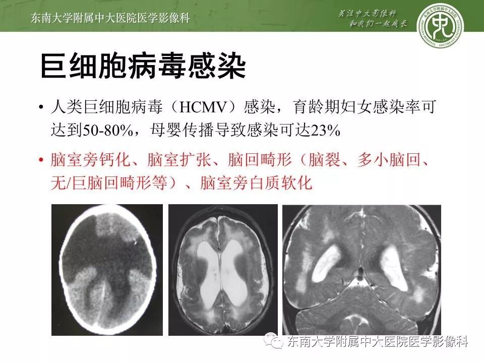 【病例】新生儿低血糖脑病2例MR影像
