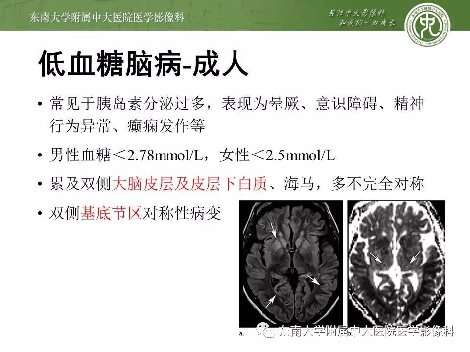 【病例】新生儿低血糖脑病2例MR影像