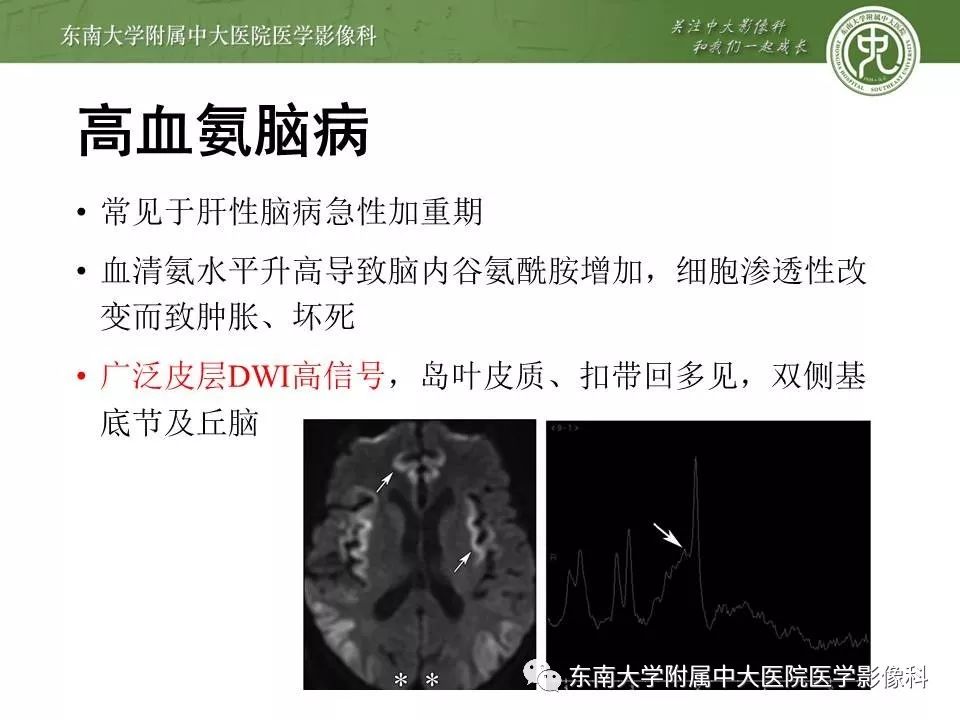 【病例】新生儿低血糖脑病2例MR影像
