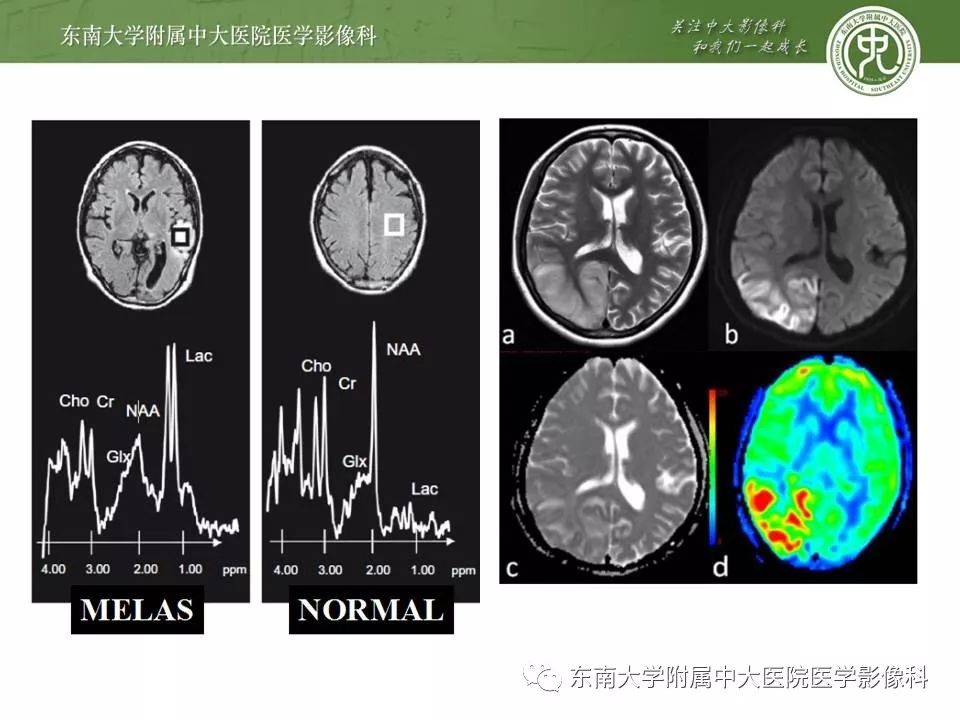 【病例】新生儿低血糖脑病2例MR影像