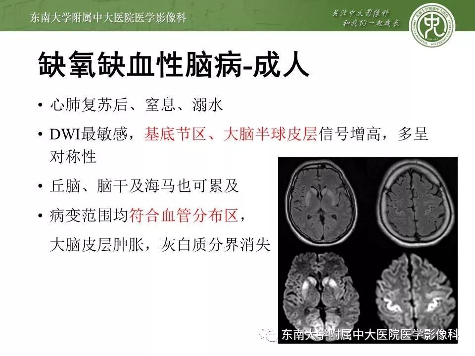 【病例】新生儿低血糖脑病2例MR影像