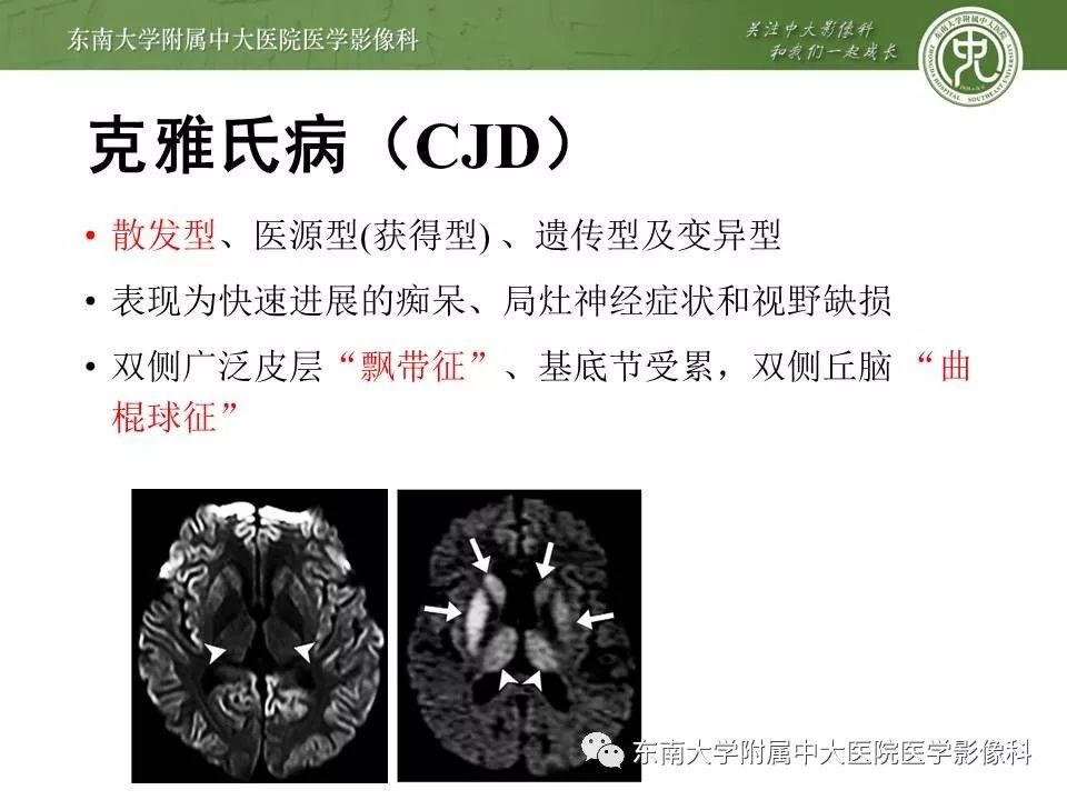 【病例】新生儿低血糖脑病2例MR影像