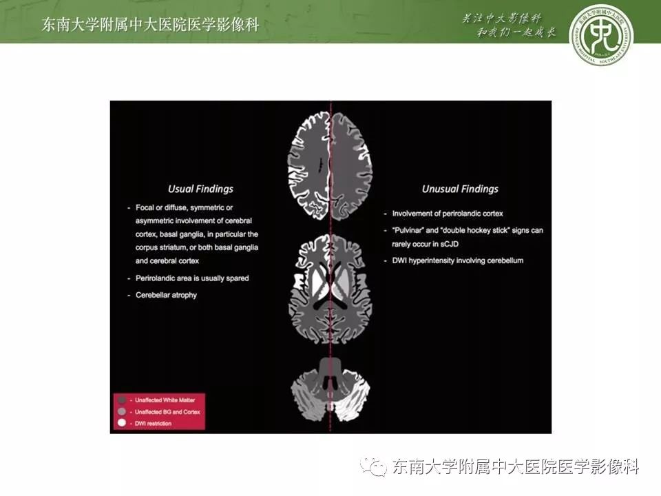 【病例】新生儿低血糖脑病2例MR影像