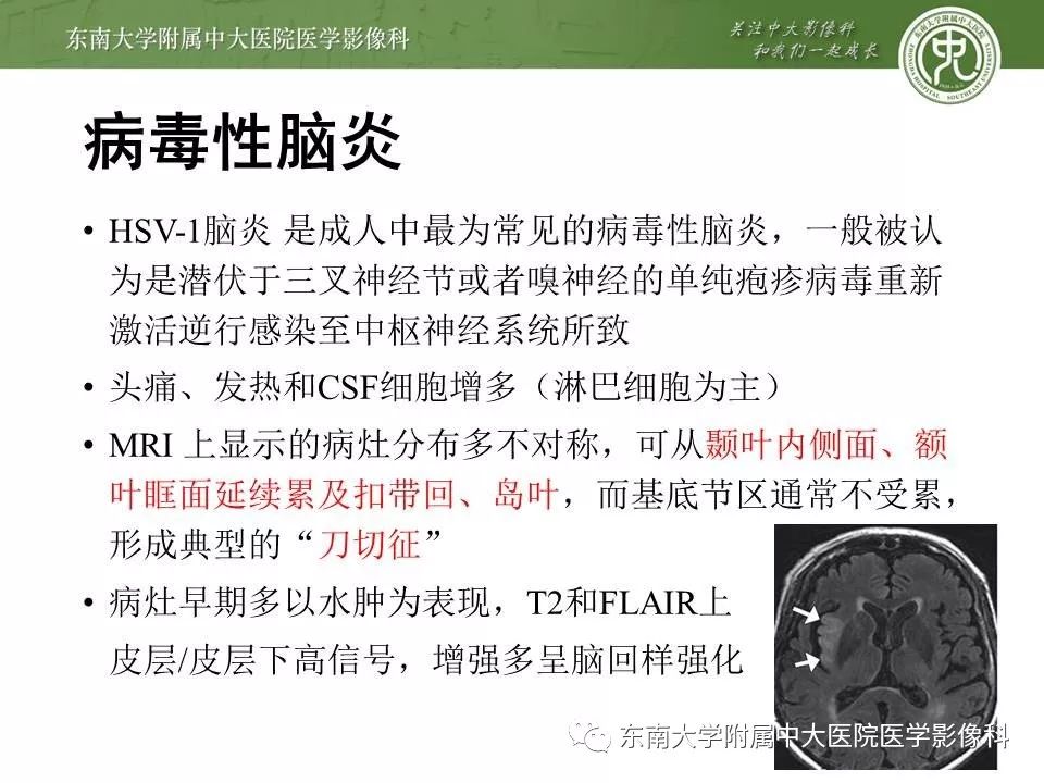 【病例】新生儿低血糖脑病2例MR影像