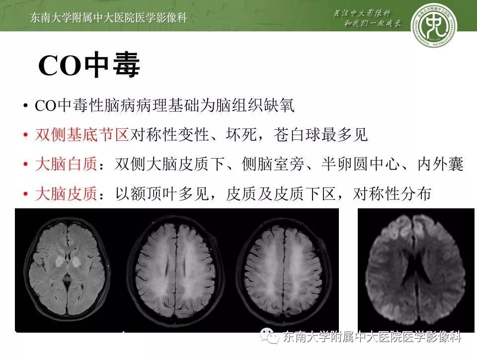 【病例】新生儿低血糖脑病2例MR影像