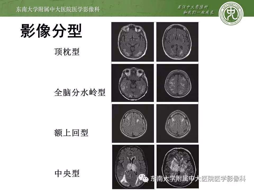 【病例】新生儿低血糖脑病2例MR影像