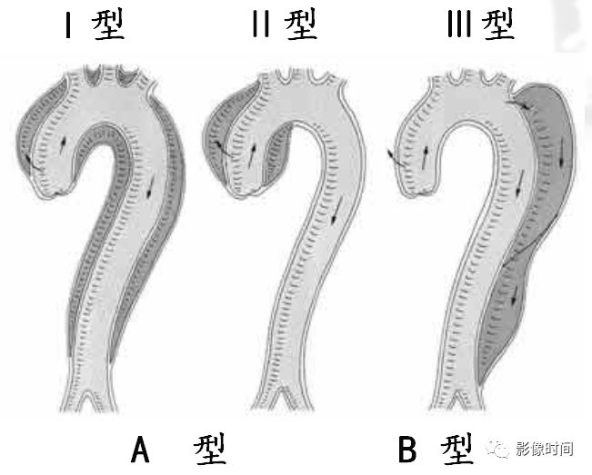 急性主动脉综合征 CTA 表现