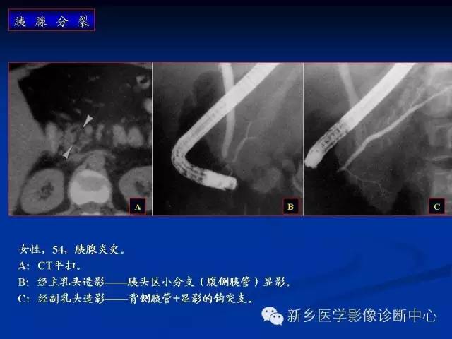 先天性胰腺分裂 先天性胰腺分裂