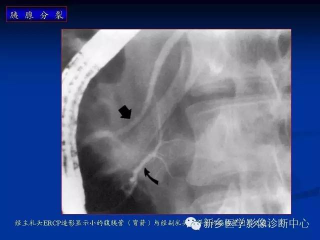 先天性胰腺分裂 先天性胰腺分裂