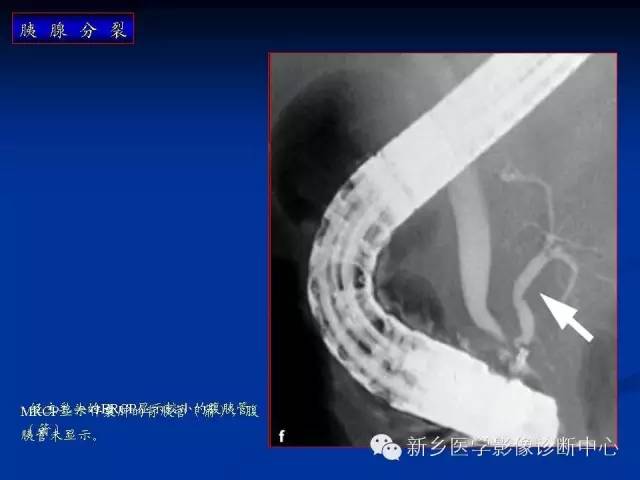 先天性胰腺分裂 先天性胰腺分裂