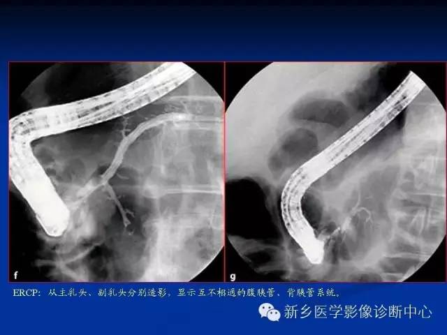 先天性胰腺分裂 先天性胰腺分裂