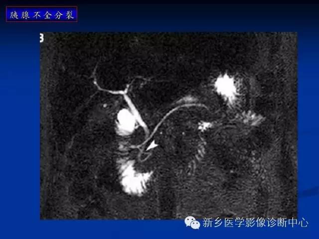 先天性胰腺分裂 先天性胰腺分裂