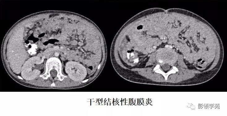 肠系膜脂膜炎的影像表现 肠系膜脂膜炎的影像表现