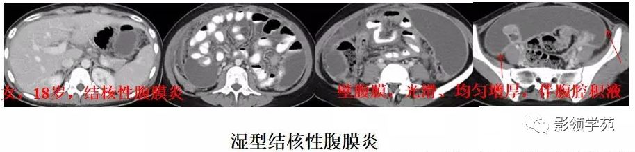 肠系膜脂膜炎的影像表现 肠系膜脂膜炎的影像表现