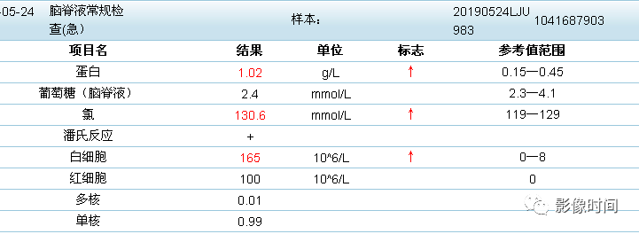 【病例】肺动静脉瘘引起反复发作脑脓肿1例CT及MR 【病例】肺动静脉瘘引起反复发作脑脓肿1例CT及MR