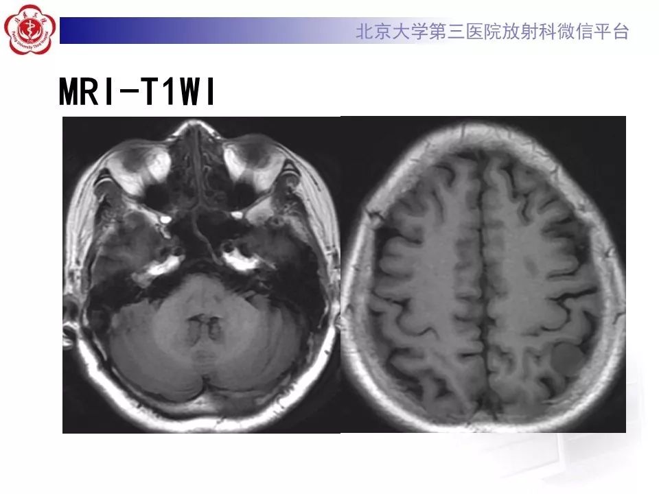 【病例】脑膜瘤1例MR影像