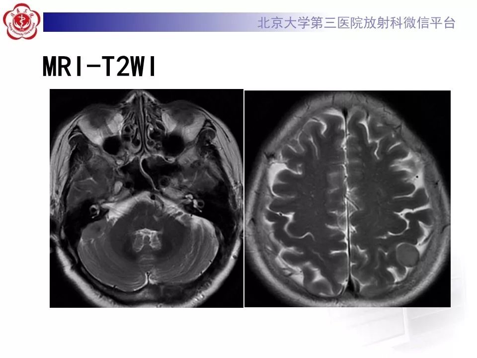【病例】脑膜瘤1例MR影像