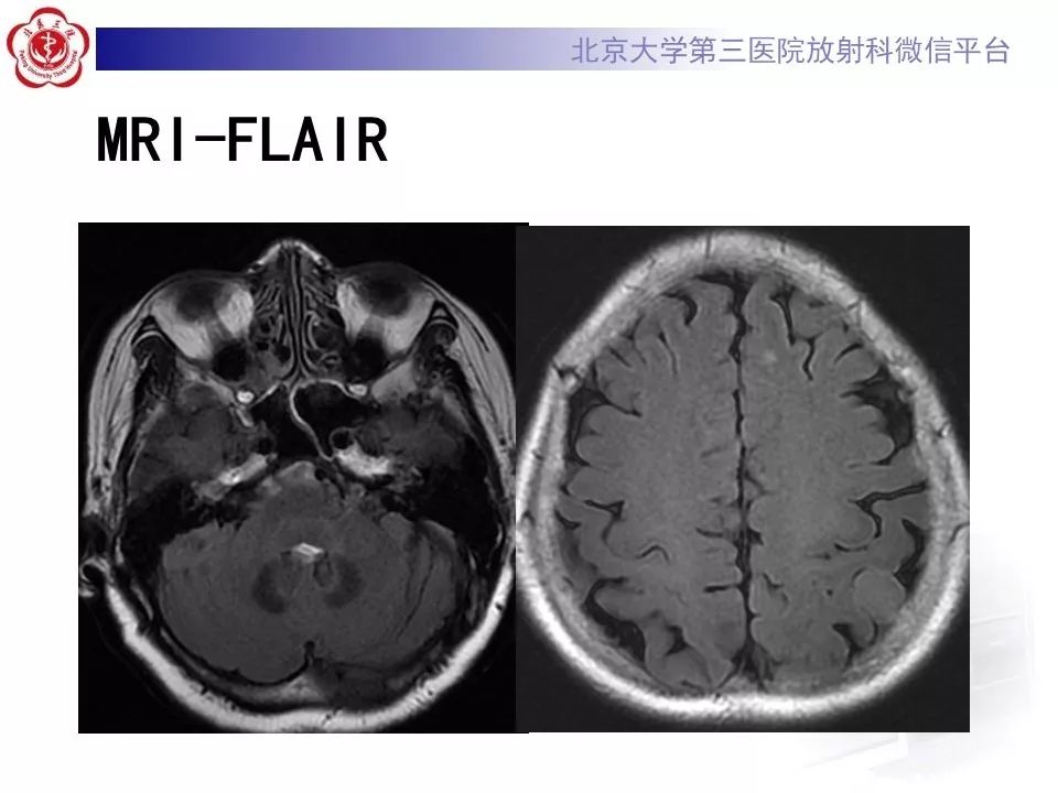 【病例】脑膜瘤1例MR影像