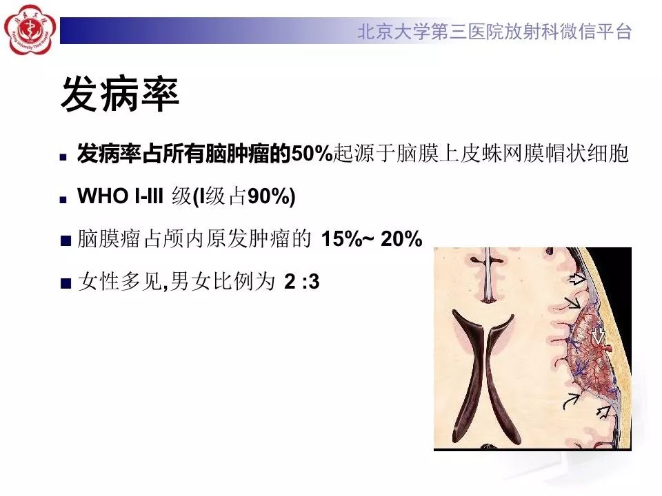 【病例】脑膜瘤1例MR影像