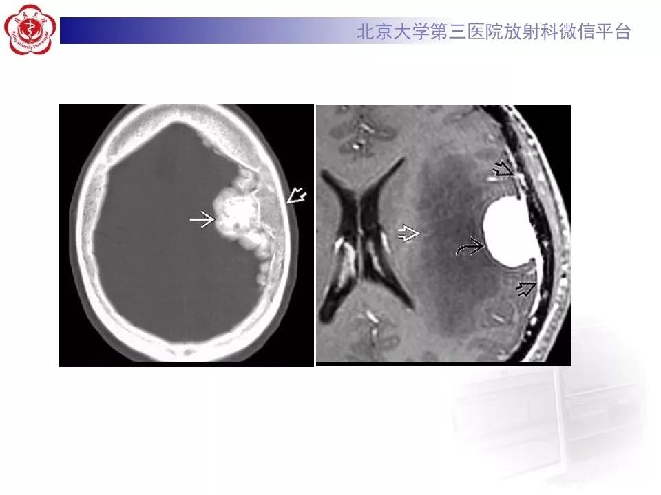 【病例】脑膜瘤1例MR影像