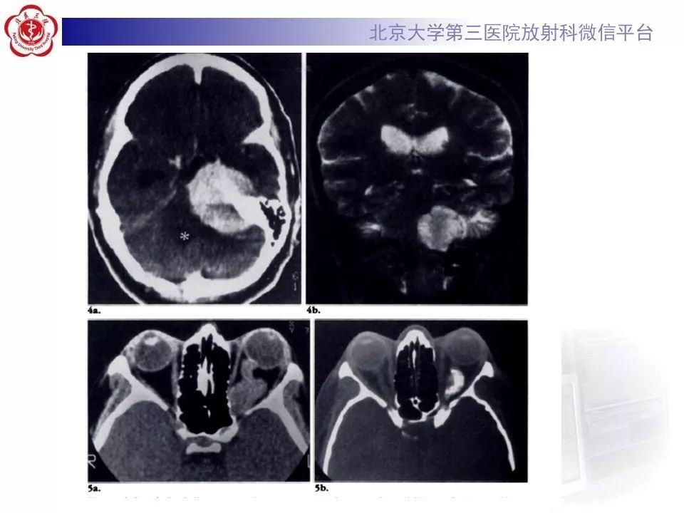 【病例】脑膜瘤1例MR影像