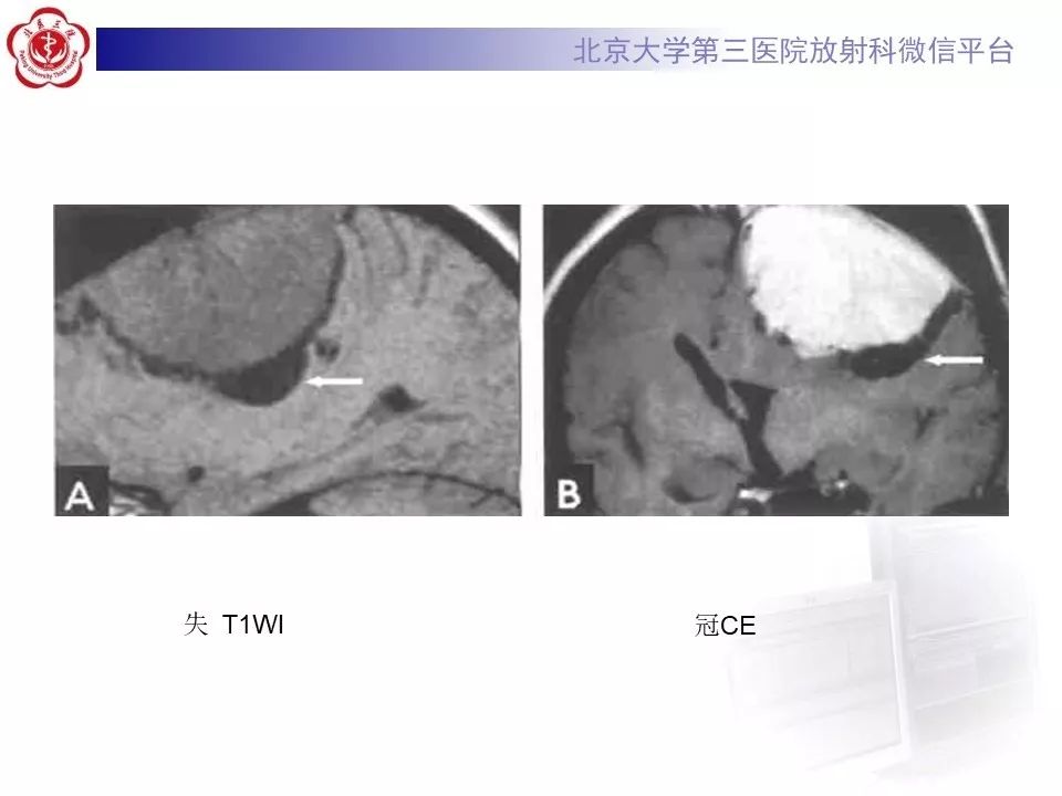 【病例】脑膜瘤1例MR影像