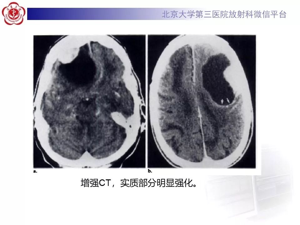 【病例】脑膜瘤1例MR影像