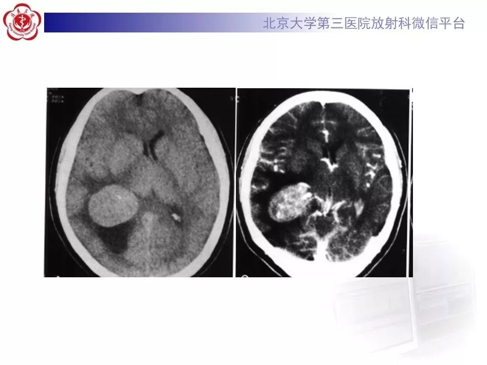 【病例】脑膜瘤1例MR影像
