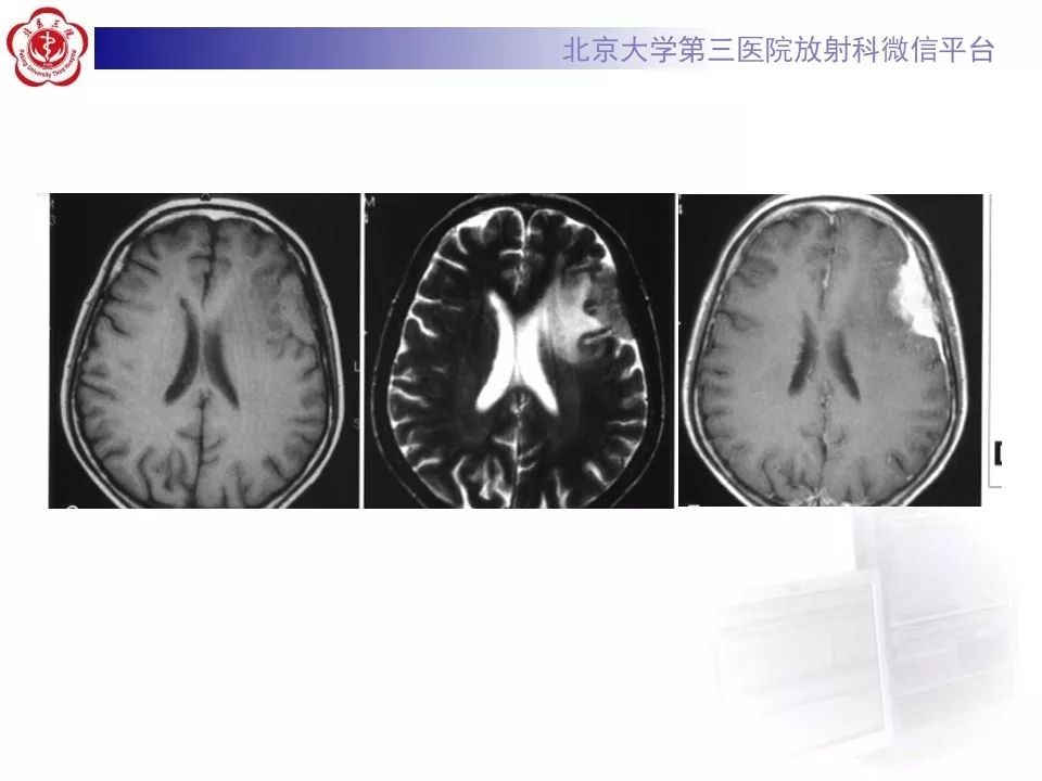 【病例】脑膜瘤1例MR影像