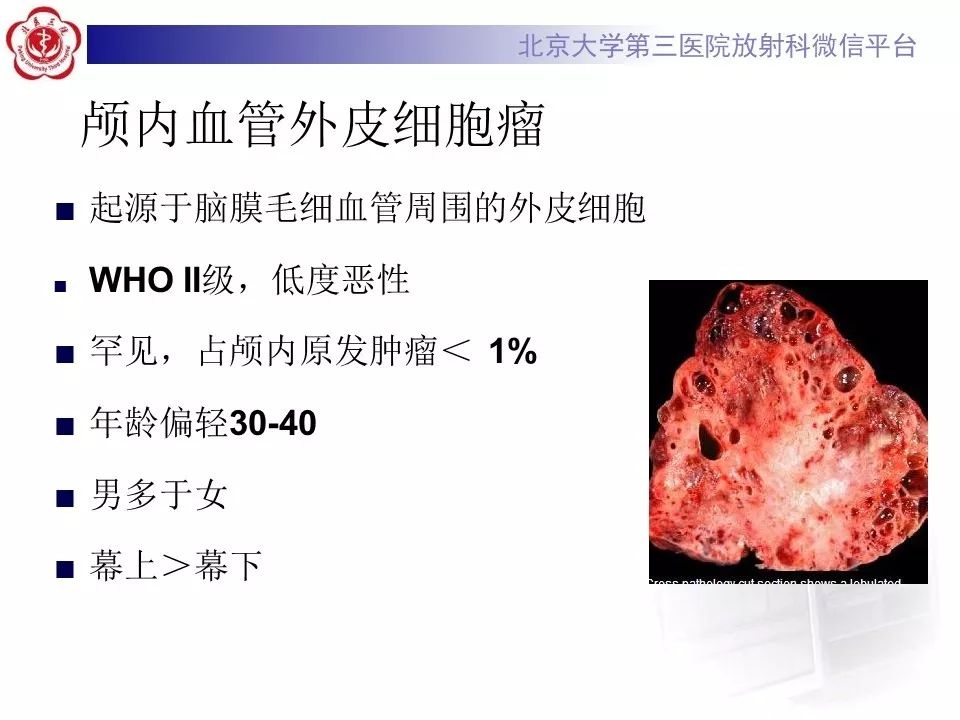 【病例】脑膜瘤1例MR影像