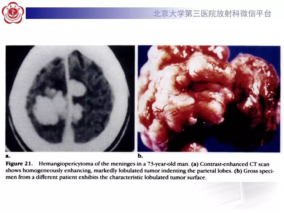 【病例】脑膜瘤1例MR影像