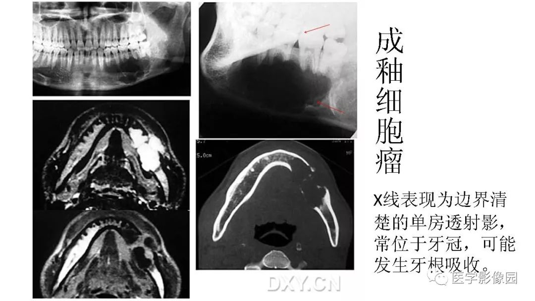 【PPT】常见口腔病例影像表现