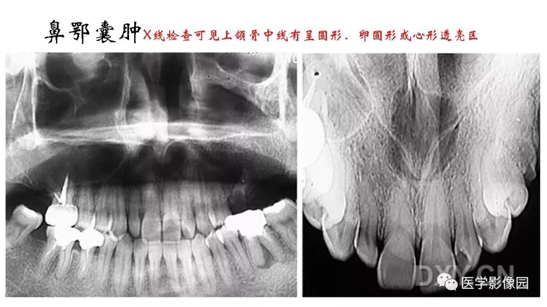 【PPT】常见口腔病例影像表现