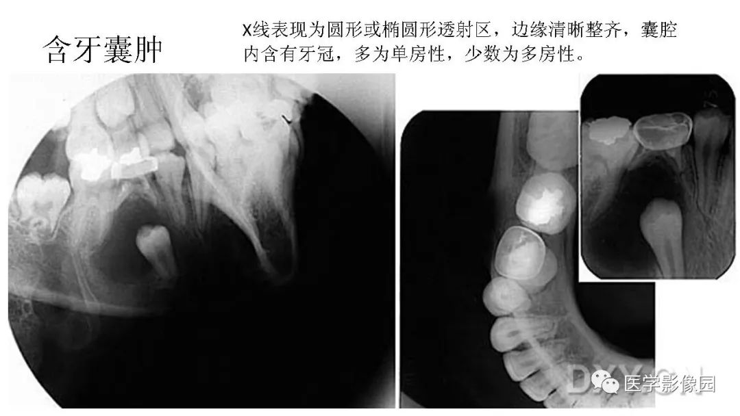 【PPT】常见口腔病例影像表现