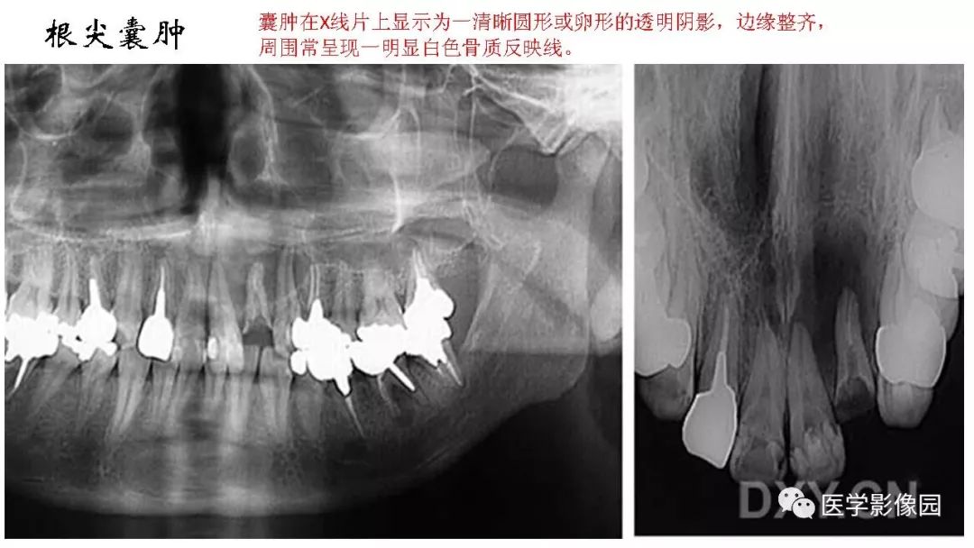 【PPT】常见口腔病例影像表现