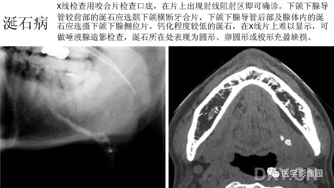 【PPT】常见口腔病例影像表现