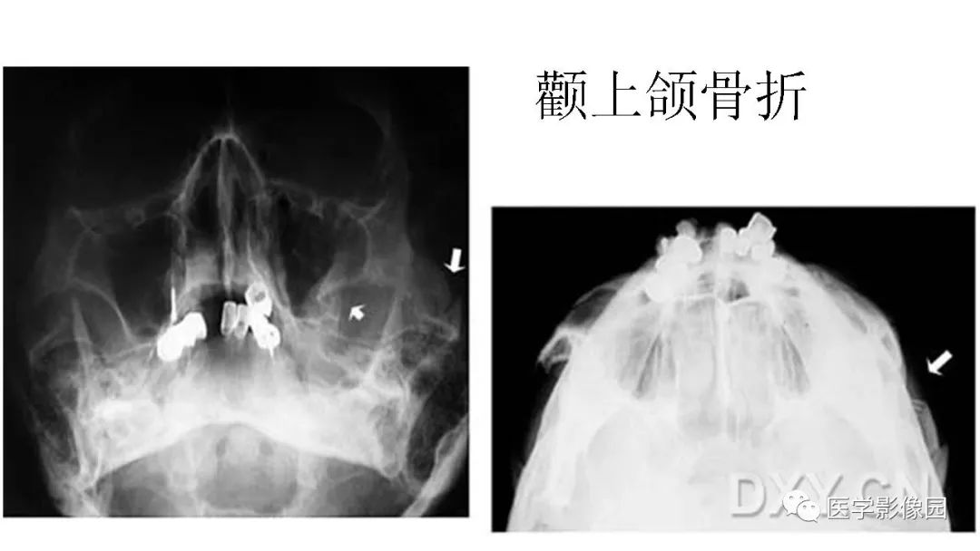 【PPT】常见口腔病例影像表现