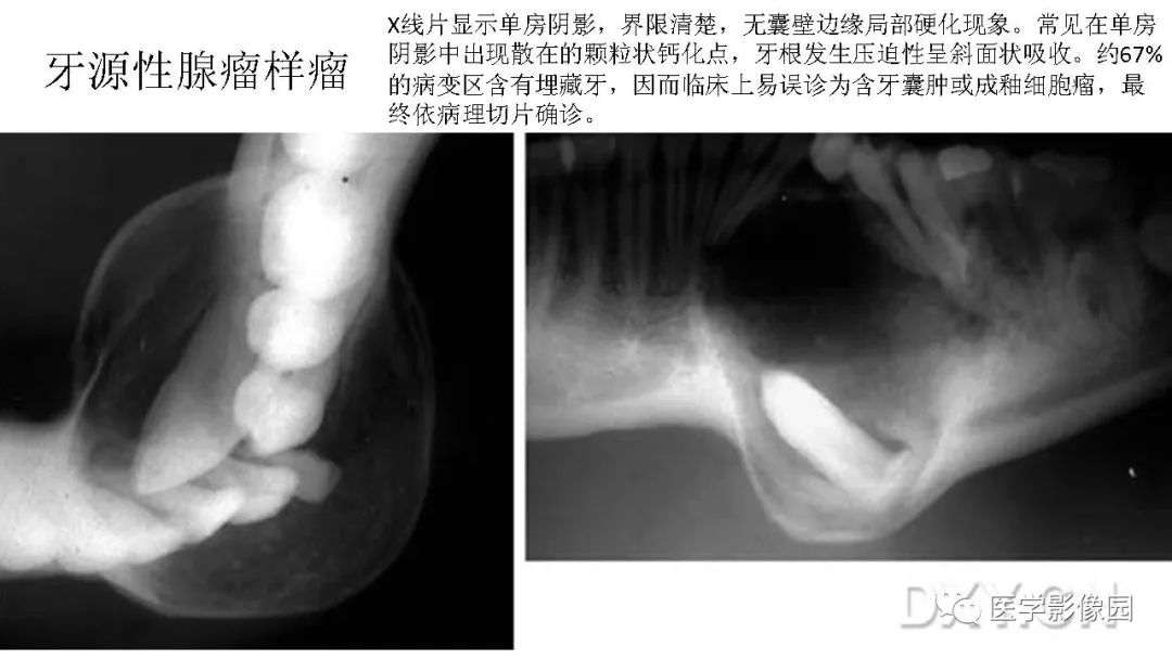 【PPT】常见口腔病例影像表现