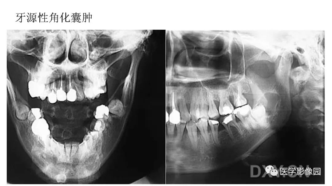 【PPT】常见口腔病例影像表现